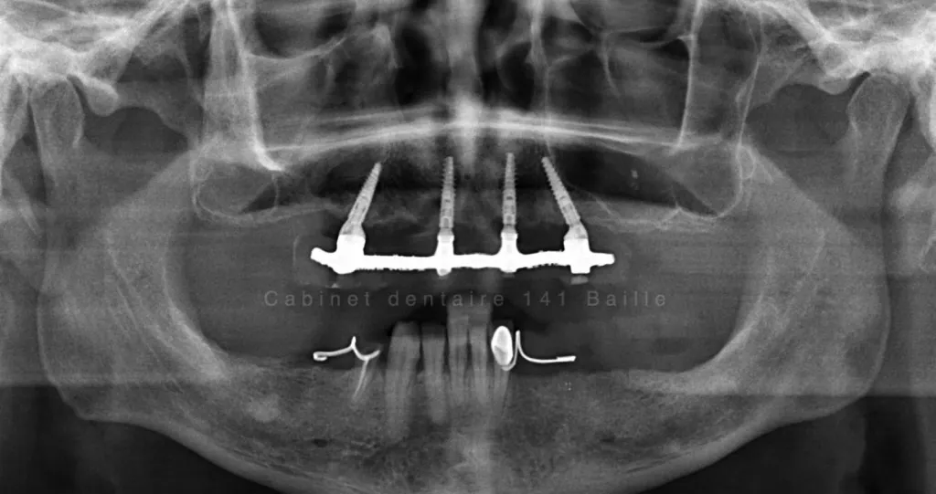 Implantologue spécialiste sur marseille