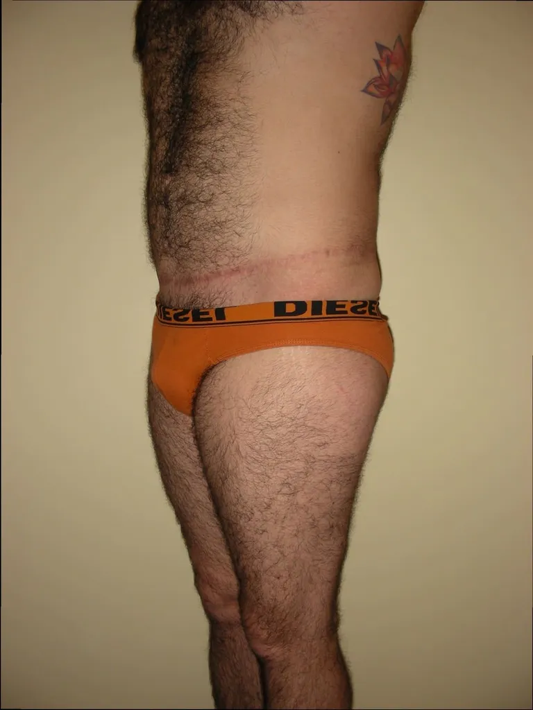 CHIRURGIE DE LA SILHOUETTE CHEZ L'HOMME, LA GYNCOMASTIE ET LE BODYLIFT