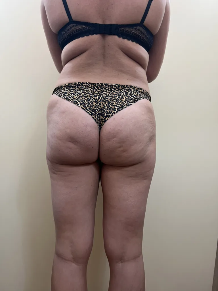 Buttock lift surgery in France: Dr Jean-François Pascal’s signature technique in Lyon