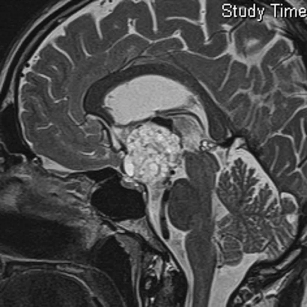 IRM T2 d'un Craniopharyngiome