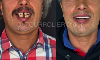 greffe de sinus et technique all on 6 par spécialiste en implantologie dentaire