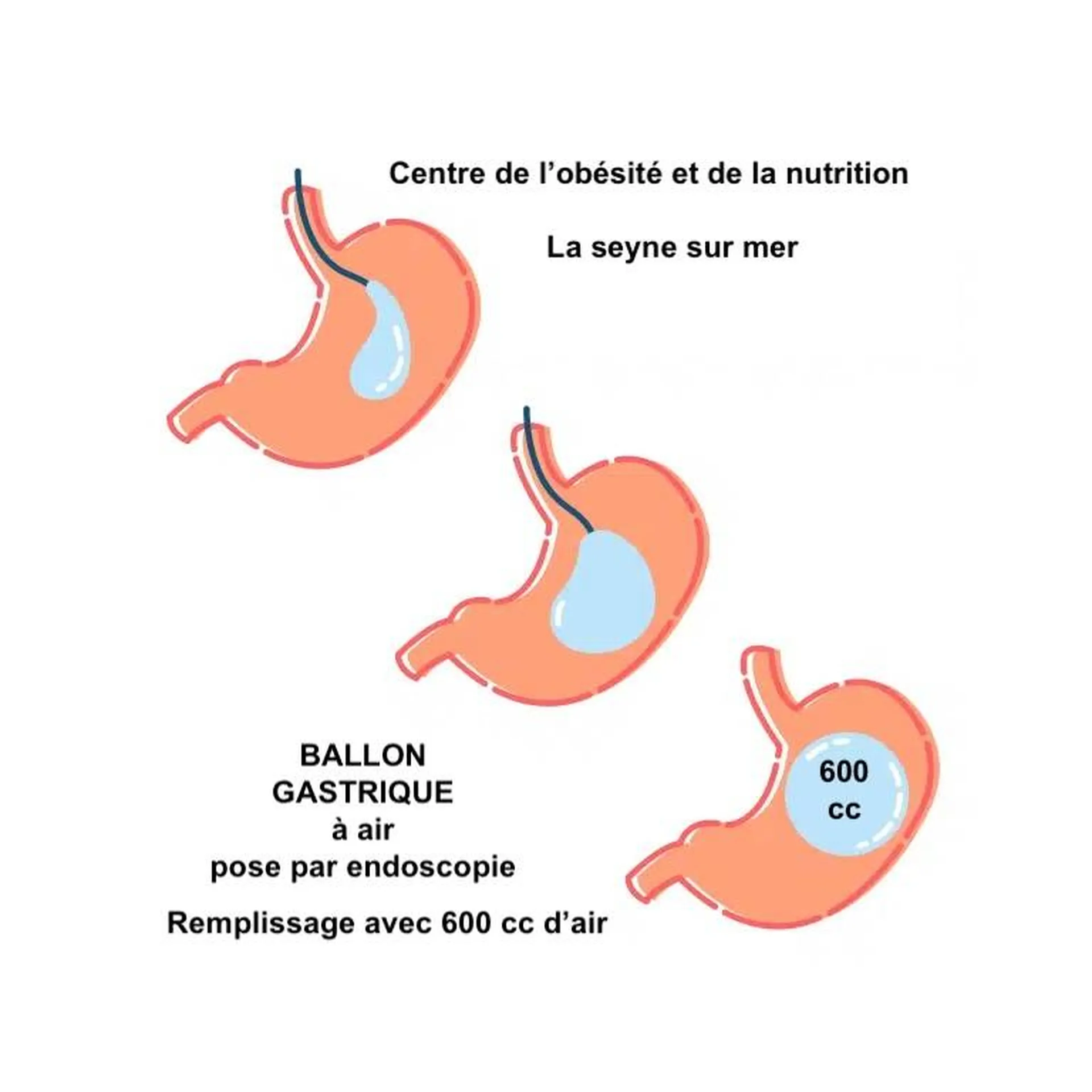 ballon gastrique 