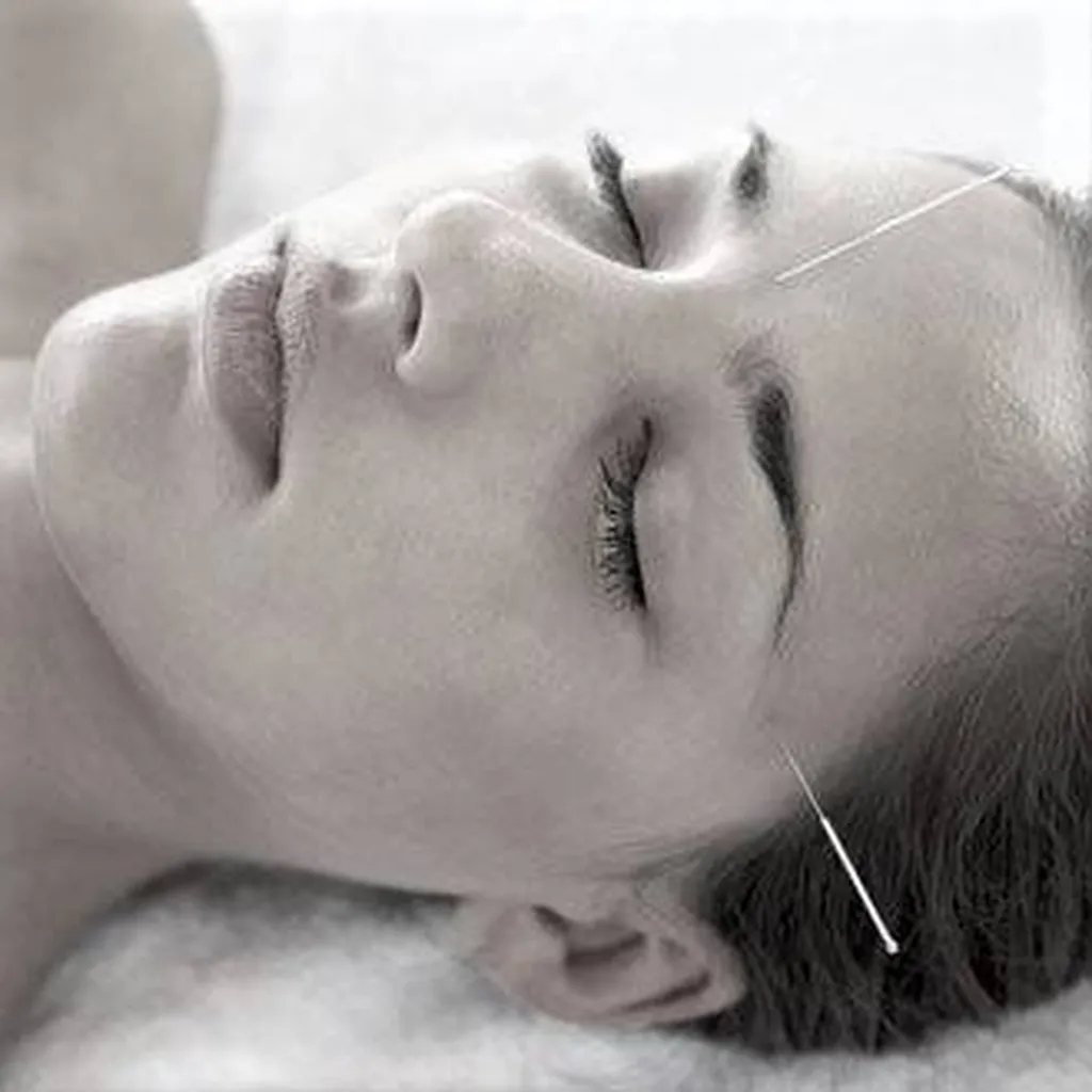 Sinusite aiguë et chronique traitée par acupuncture à Lyon