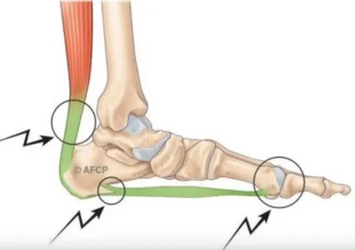 Dr Julien Beldame et la rétraction du tendon d'Achille, ICP Amiens